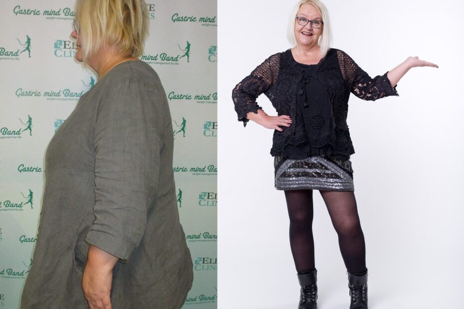 Do I need to lose weight before knee or hip surgery