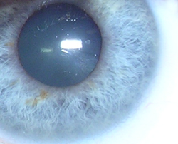 Diabetes can cause eye damage