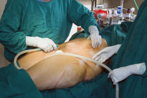 Cheapest Bariatric Weight Loss Surgery - Low Cost Gastric Band