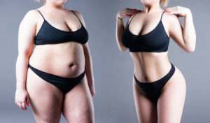 Obesity Surgery NHS