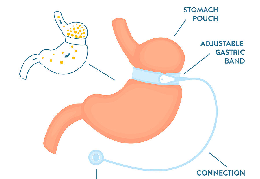 all about gastric band surgery