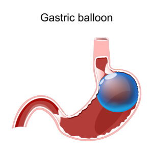 Gastric Balloon - My Weigh Less