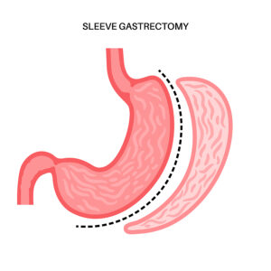 surgery-free weight loss