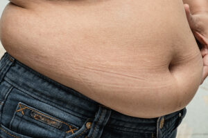 Why am I overweight and fat if I hardly eat anything 