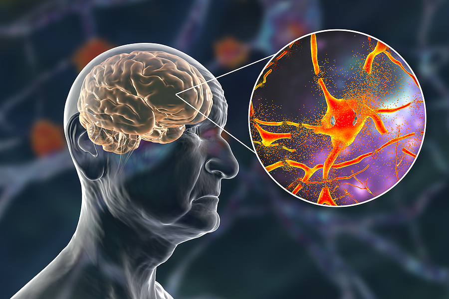 Dementia and Obesity